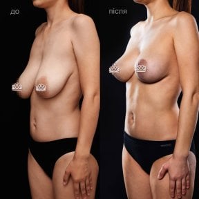 Résultats avant et après réduction mammaire à la Vidnova Clinic, forme améliorée des seins