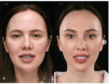 Before and after Deep Plane Facelift results at Vidnova Clinic – facial rejuvenation outcome