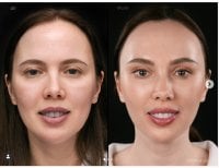 Before and after Deep Plane Facelift results at Vidnova Clinic – facial rejuvenation outcome