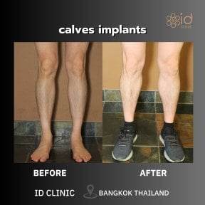 before-after photo vaser-liposuction