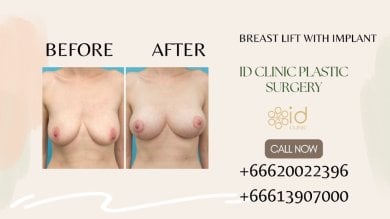 Before and after breast lift with implant results at ID Clinic Bangkok, improved breast contour