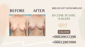 Before and after breast lift with implant results at ID Clinic Bangkok, improved breast contour