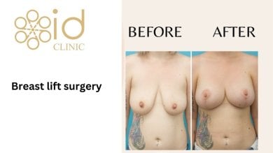 Before and after breast lift surgery results at ID Clinic Bangkok, improved breast contour