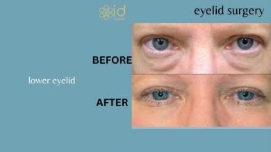 Before and after lower eyelid surgery results at ID Clinic Bangkok, reduced under-eye bags