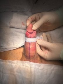 Penis filler procedure result at Uroaesthetic – increased girth measured during treatment