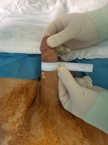 Penis filler procedure result at Uroaesthetic – visible girth enhancement after treatment
