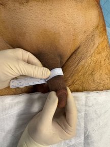Penis filler procedure result at Uroaesthetic, visible girth enhancement with measurement