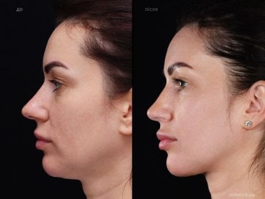 Результати підтяжки шиї до і після у клініці Vidnova – покращений контур шиї та щелепи