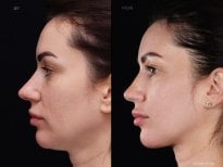 Результати підтяжки шиї до і після у клініці Vidnova – покращений контур шиї та щелепи