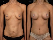 Résultats avant/après abdominoplastie et augmentation mammaire à la Vidnova Clinic
