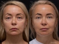 Результат до та після deep plane SMAS підтяжки у Vidnova Clinic – помітне омолодження обличчя