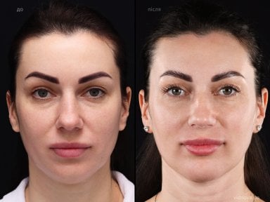 Результати до і після Deep Plane Facelift у клініці Vidnova – омолодження обличчя