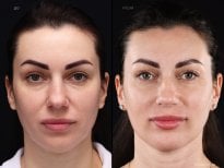 Результати до і після Deep Plane Facelift у клініці Vidnova – омолодження обличчя