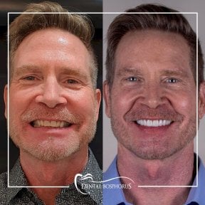 Before and after All-on-6 dental implants result at Dental Bosphorus, improved smile aesthetics