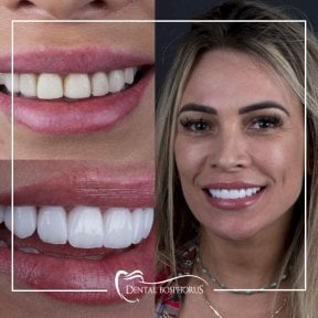 Результат до и после установки виниров Emax в Dental Bosphorus, естественная улыбка