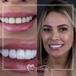 Результат до и после установки виниров Emax в Dental Bosphorus, естественная улыбка