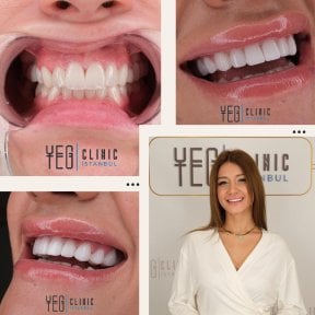 Lumineer Veneers Ergebnis bei YEG Clinic, natürliche weiße Zahnverwandlung