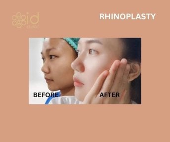 before-after photo rhinoplasty-nose-job