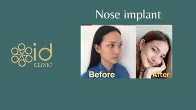before-after photo rhinoplasty-nose-job