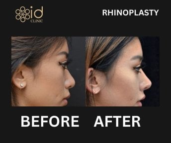 before-after photo rhinoplasty-nose-job
