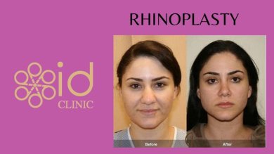 before-after photo rhinoplasty-nose-job