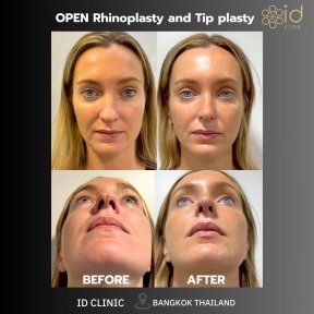 before-after photo rhinoplasty-nose-job