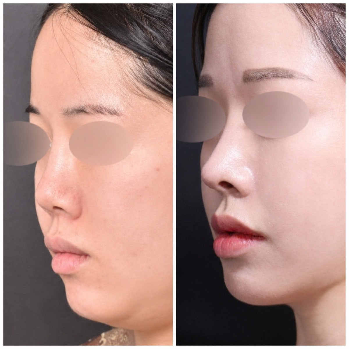 Antes y después de rinoplastia en VG Plastic Surgery, resultado de perfil nasal refinado
