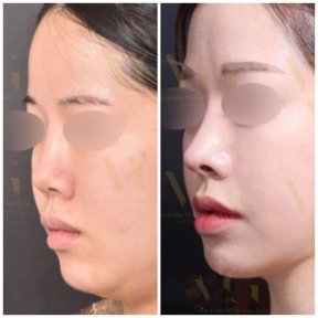До и после ринопластики в VG Plastic Surgery, результат утончённого профиля носа