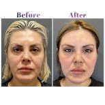 Vorher-nachher-Ergebnis Mini-Facelift bei Db'est Clinic – sichtbare Gesichtsverjüngung