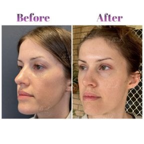 Vorher-nachher-Ergebnis Deep Plane Facelift bei Db'est Clinic, sichtbare Verjüngung