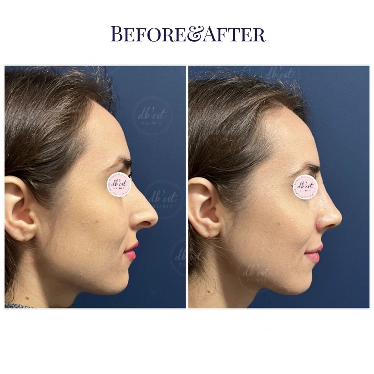 Resultados de rinoplastia antes y después en Db'est Clinic, perfil nasal natural