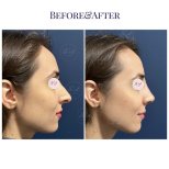 Vorher-nachher-Ergebnis der Nasenkorrektur bei Db'est Clinic, natürliches Profil