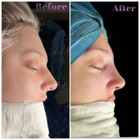 Vorher-nachher-Rhinoplastik-Ergebnisse bei Db'est Clinic, verbesserte Nasenform und Profil