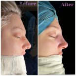 Vorher-nachher-Rhinoplastik-Ergebnisse bei Db'est Clinic, verbesserte Nasenform und Profil