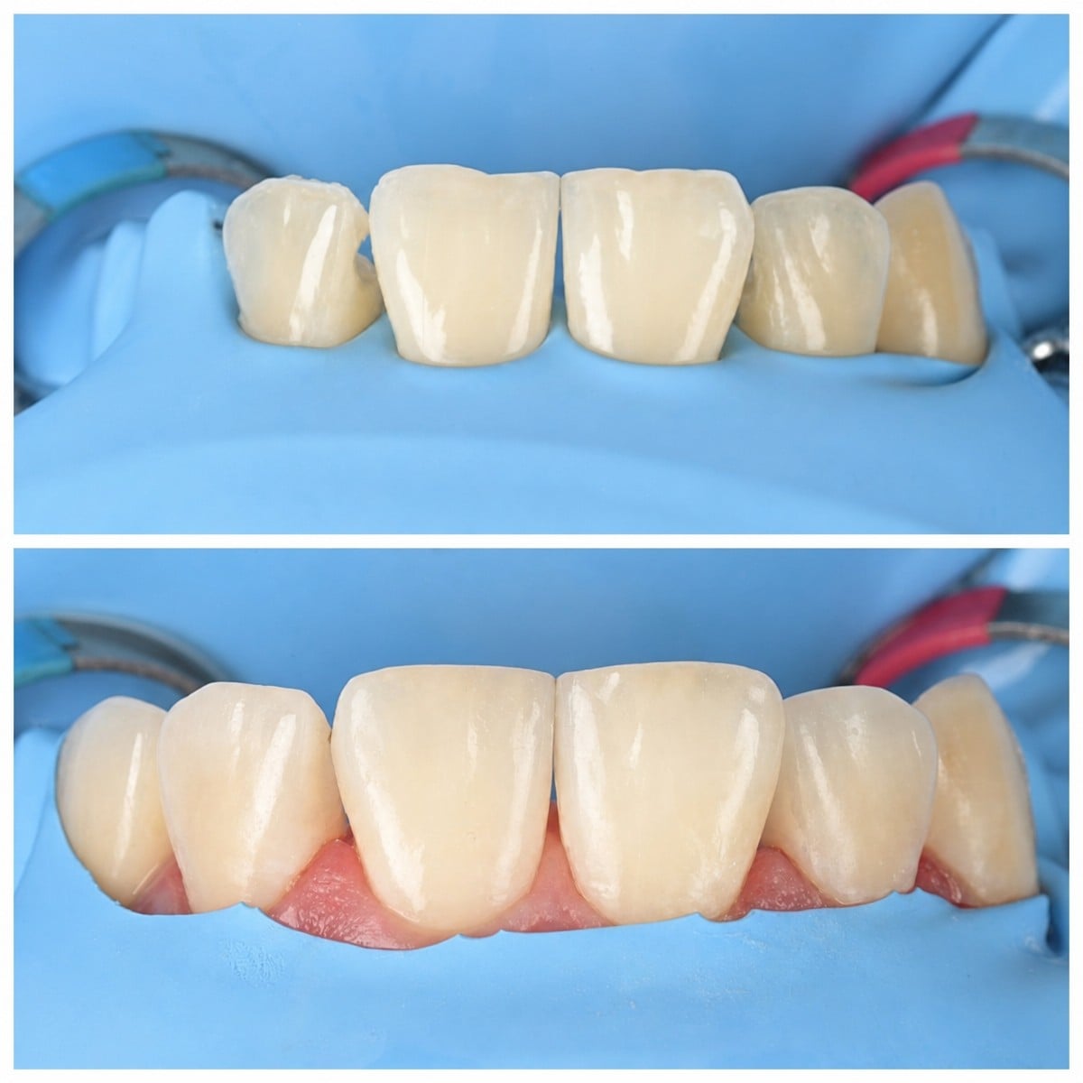 Resultados antes y después de restauración dental con bonding en RIKOTA Dental Clinic