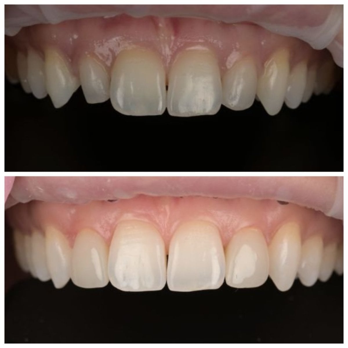 Resultados de antes y después de bonding dental en RIKOTA Dental Clinic para dientes frontales