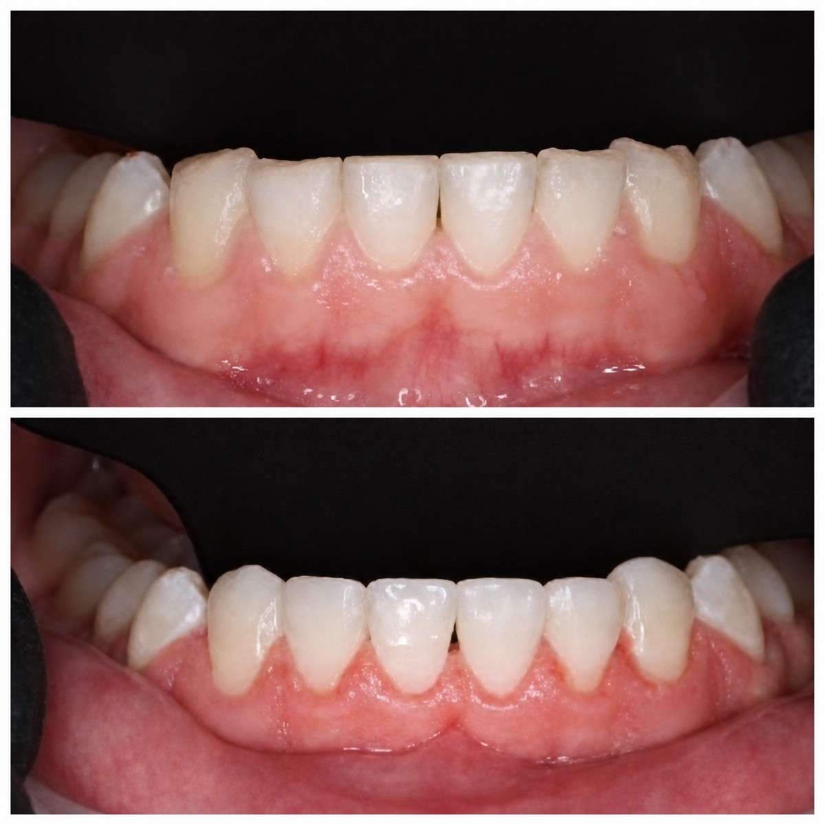 Resultados de antes y después de bonding dental en RIKOTA Dental Clinic para mejorar forma dental