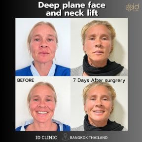 before-after photo tightening-of-facial-skin-facelift