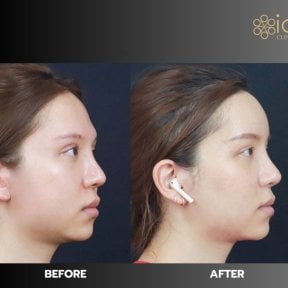 before-after photo forehead-augmentation-implant