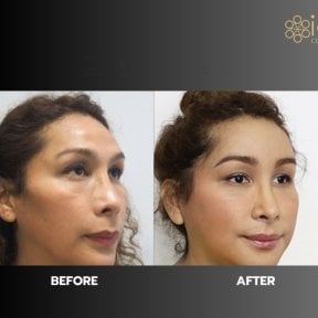 before-after photo forehead-augmentation-implant
