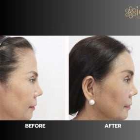 before-after photo forehead-augmentation-implant