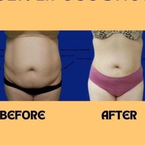 before-after photo bodytite-body-contouring