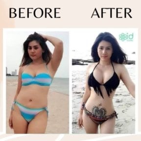 before-after photo bodytite-body-contouring