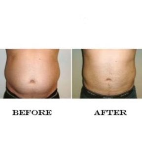 before-after photo vaser-liposuction