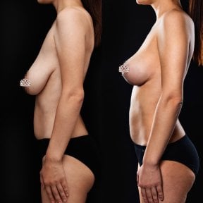 Before and after breast reduction results at Vidnova Clinic, improved breast shape and lift