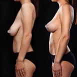 Before and after breast reduction results at Vidnova Clinic, improved breast shape and lift