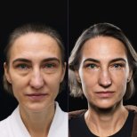 Resultados de blefaroplastia de párpado inferior antes y después en Vidnova Clinic, menos bolsas