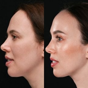 Результаты до и после подтяжки шеи в клинике Vidnova – улучшенный контур шеи и челюсти