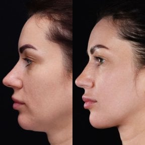 Before and after neck lift results at Vidnova Clinic – improved jawline and neck contour