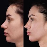 Before and after neck lift results at Vidnova Clinic – improved jawline and neck contour